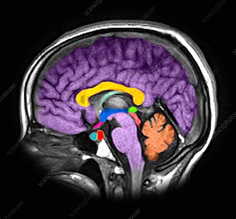 Enhanced Normal Sagittal Mri Brain Stock Image C0435536 Science