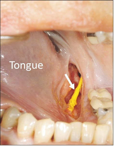 An Anatomical Study Of The Lingual Nerve In The Lower Third Molar Area