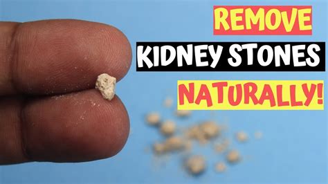 2 Best Remedies To Remove Kidney Stones Naturally In Men Kidney
