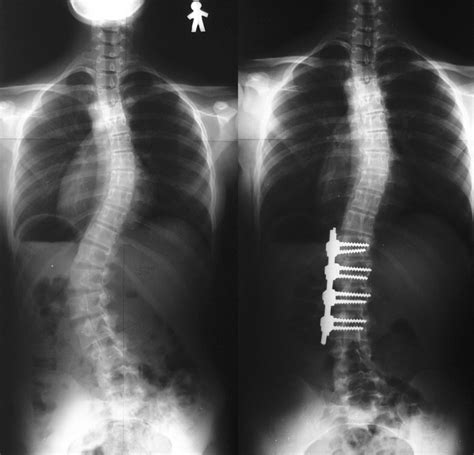 Surgical Treatment Of Scoliosis A Review Of Techniques Currently
