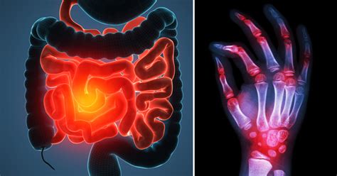 Learn what to look for so you can avoid triggers and ease your eczema symptoms. 5 Foods That Trigger Autoimmune Disease Flare-Ups - David ...
