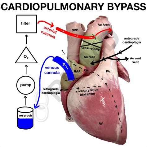 What Is Cardiopulmonary Bypass Cpb Rkmd