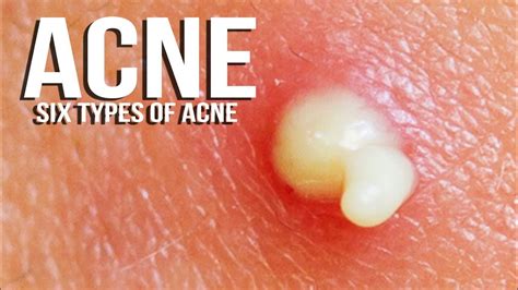 5 Types Of Acne Blackheads Pimples Cysts And Pustules Youtube
