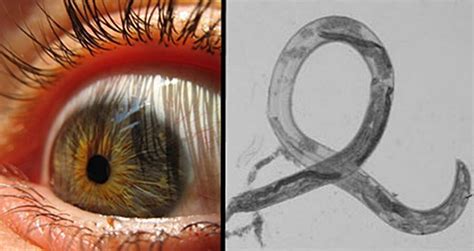 A Woman Found Parasitic Worms In Her Eye — And They Were Breeding