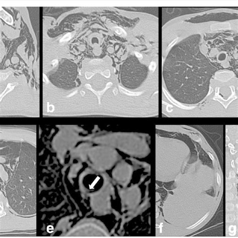 Computed Tomography Scan Of The Thorax Showed Subcutaneous Soft Tissue