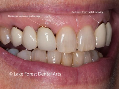 For How Long Do Teeth Whitening Last Dental Expert Contrasts Methods