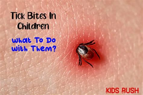Tick Bites In Children What To Do With Them