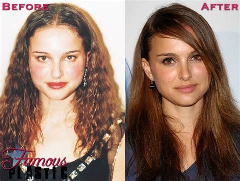 Celebrity Nose Job Pictures Photos of Stars Before and After Rhinoplasty Revolución del