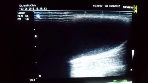 Bakers Cyst Ultrasound Youtube
