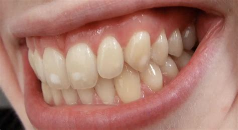 Prevent Calcium Deposits On Your Teeth Royal Dental Clinics Blog