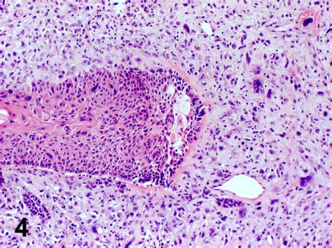 Pathology Outlines Conventional Squamous Cell Carcinoma