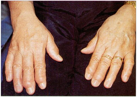 Rheumatology 5 Diagnosis And Management Of Inflammatory Polyarthritis