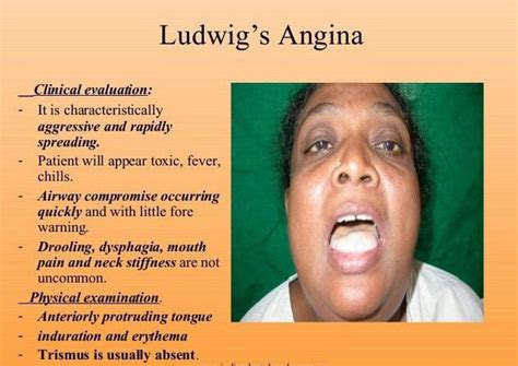 Symptom Of Ludwig Angina Medizzy