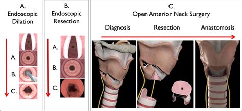 Treatment Options In Idiopathic Subglottic Stenosis Protocol For A