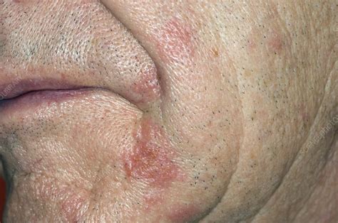 Shingles Rash On The Face Stock Image C0085780 Science Photo Library
