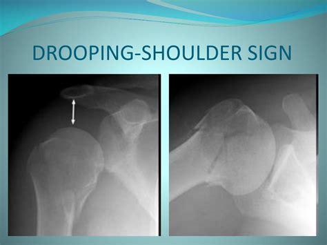 PPT - SIGNS IN RADIOLOGY PowerPoint Presentation, free ...