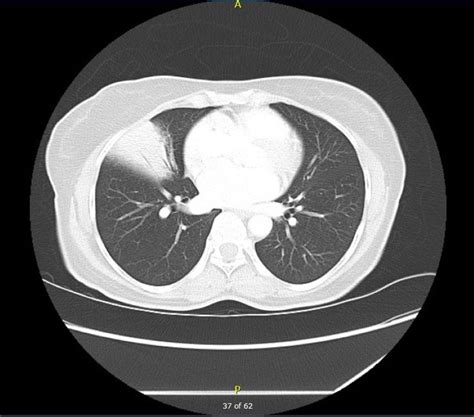 Cureus Right Middle Lobe Single Pulmonary Opacity With Air