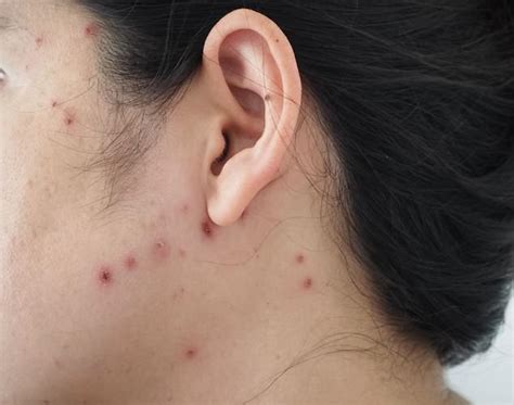 New Mothers Infected With Chickenpox In Mix Up At Sydney Hospital