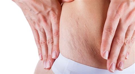 tips and tricks get rid of the stretch marks naturally check details