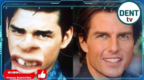 Tom Cruise Teeth Before And After Braces Before And After Photos That Prove Good Teeth Can