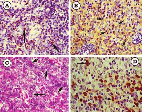 A Numerous Bcl 2 Positive Cells In A Hyperplastic Thymus Download