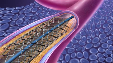 Video What Is A Heart Stent Healthclips Online