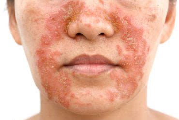 Rimedi Naturali Dermatite Seborroica Non Sprecare