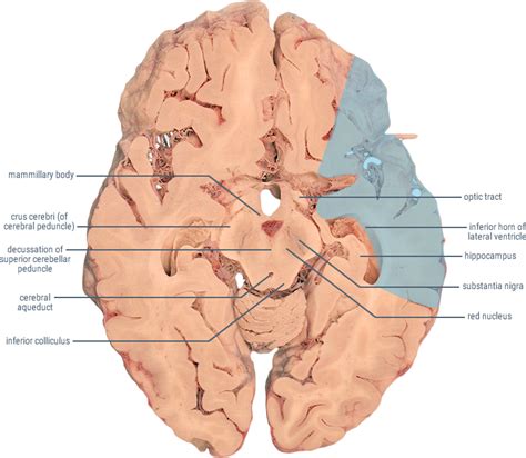 Others are preceded by transient symptoms. Middle Cerebral Artery