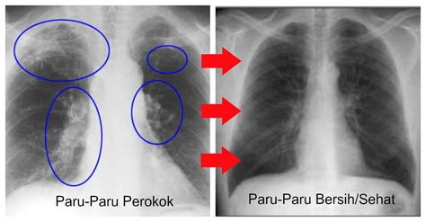 Tetapi ada beberapa diagnosa lain yang tetap mendatangkan simptom yang. Paru - Paru Perokok Bisa Bersih Lagi Hanya Dengan Rajin ...