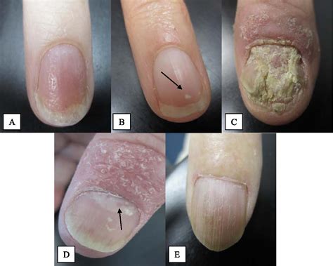 Figure 2 From Psoriatic Arthritis And Nail Changes Exploring The