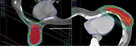 Prone Versus Supine Position For Adjuvant Breast Radiotherapy A