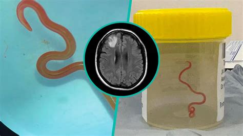 Doctors Find Worm Found In Pythons In Australian Woman S Brain