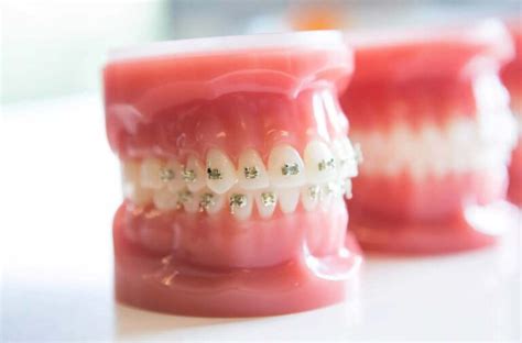 Orthodontics Australia Periodontal Disease And Orthodontic Braces
