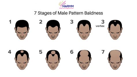 Male Pattern Baldness Stages And Treatments