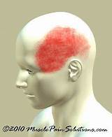 Left Side Pain Headache Causes Photos