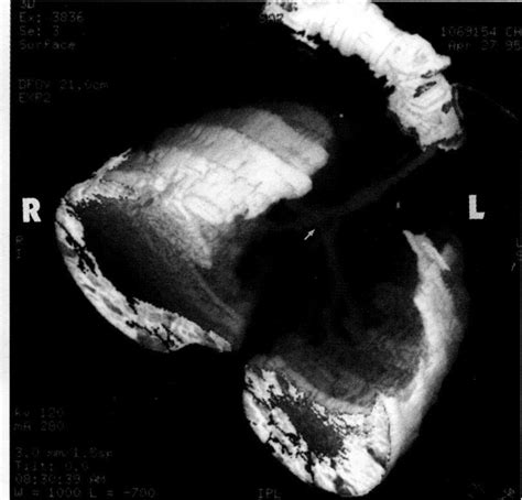 Right Anterior Oblique View Of 3d Ct Image Of The Lungs In A Four Year