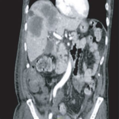 Ct Of The Abdomen And Pelvis With Iv Contrast Demonstrating Hepatic