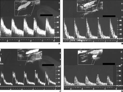 Carotid Ultrasound Waveforms