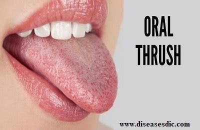 Oral Thrush Symptoms Causes And Medications