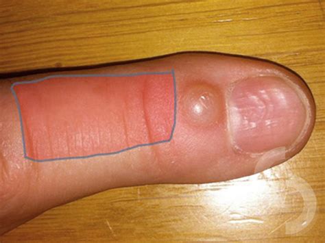 Finger Ganglion Mucous Cyst Dr Sonja Cerovac