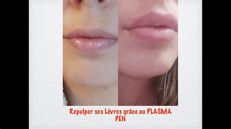 Solution Facile Et Permanente Pour Repulper Ses Lèvres Plasma Pen Lip Flip A La Maison Youtube