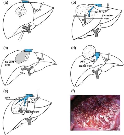 Anatomic Liver Resection Of Right Paramedian Sector Ventral And Dorsal