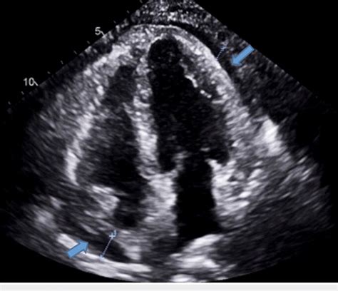 Apical Chamber View Showing A Moderate Pericardial Effusion