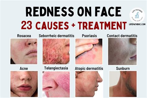 Redness On Face 23 Causes And How To Reduce It