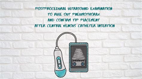 Post Procedural Ultrasound Examination To Rule Out Pneumothorax And