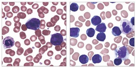 T Cell Large Granular Lymphocytic Leukemia Basicmedical Key