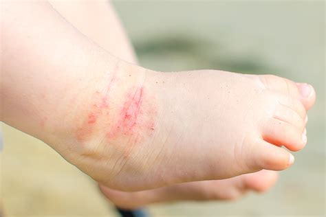 Tehnici Noi De Diagnosticare Pentru Dermatita Atopica Utile In