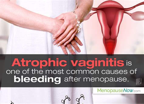 Causes Of Vaginal Bleeding After Menopause Pristyn Care Hot Sex Picture