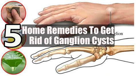 5 Home Remedies To Get Rid Of Ganglion Cysts Youtube