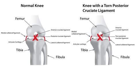 Knee ligament injuries do not distinguish by age. Knee Pain and Problems from Injuries, Arthritis ...